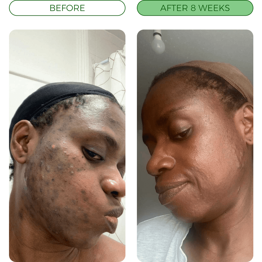 💛Turmeric Acne Killing Bar✅ - Deep Pore Cleansing & Repair Ritual