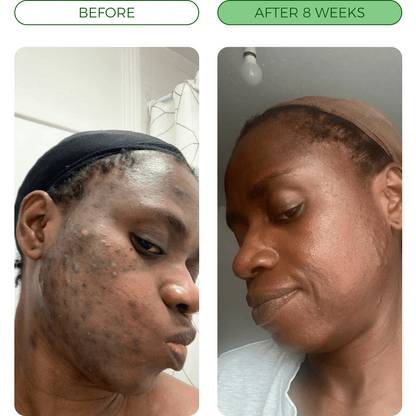 💛Turmeric Acne Killing Bar✅ - Deep Pore Cleansing & Repair Ritual