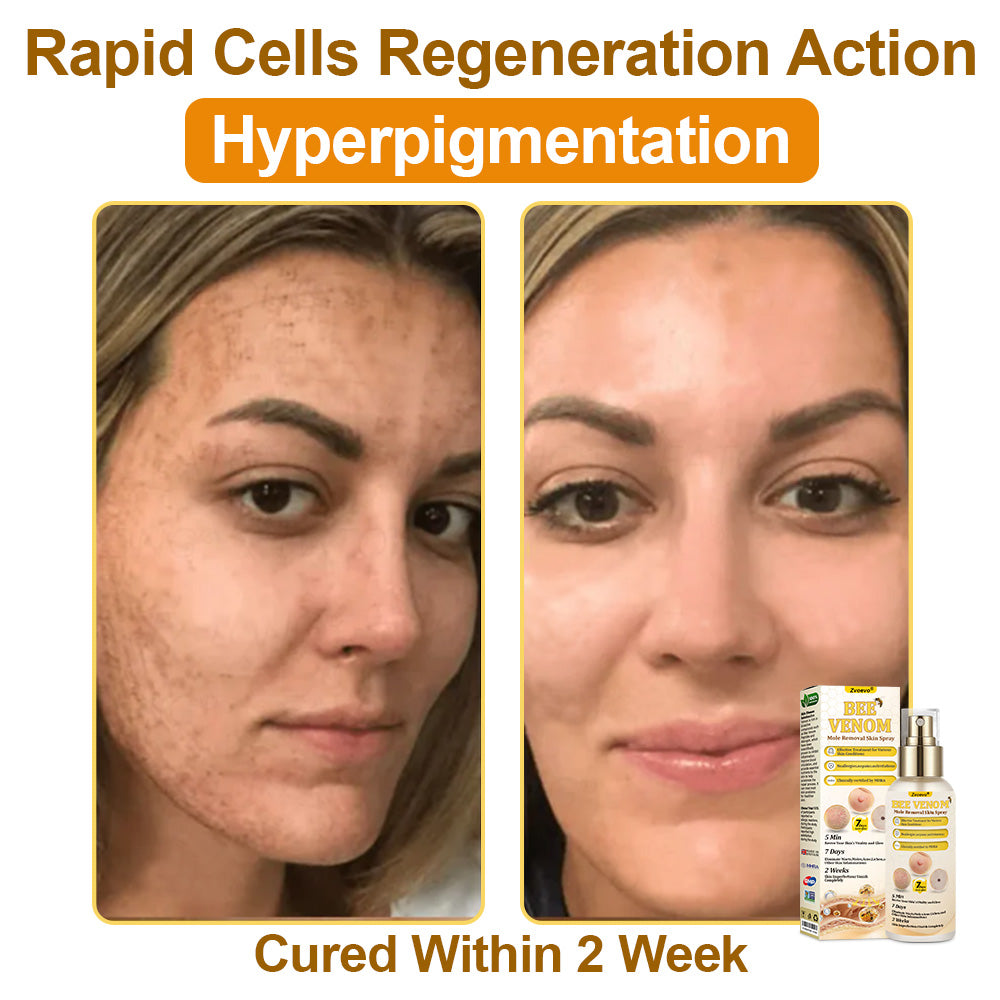 🐝𝐳𝐯𝐨𝐞𝐯𝐨® 𝐁𝐞𝐞 𝐕𝐞𝐧𝐨𝐦 𝐒𝐤𝐢𝐧 𝐒𝐩𝐫𝐚𝐲 – Dermatologist-recommended, provides effective relief for stubborn warts, skin bumps, infections, scars, and various skin concerns.