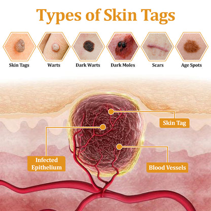 flysmus™ TagCure Bee Venom Wart & Moles Removal Cream🐝
