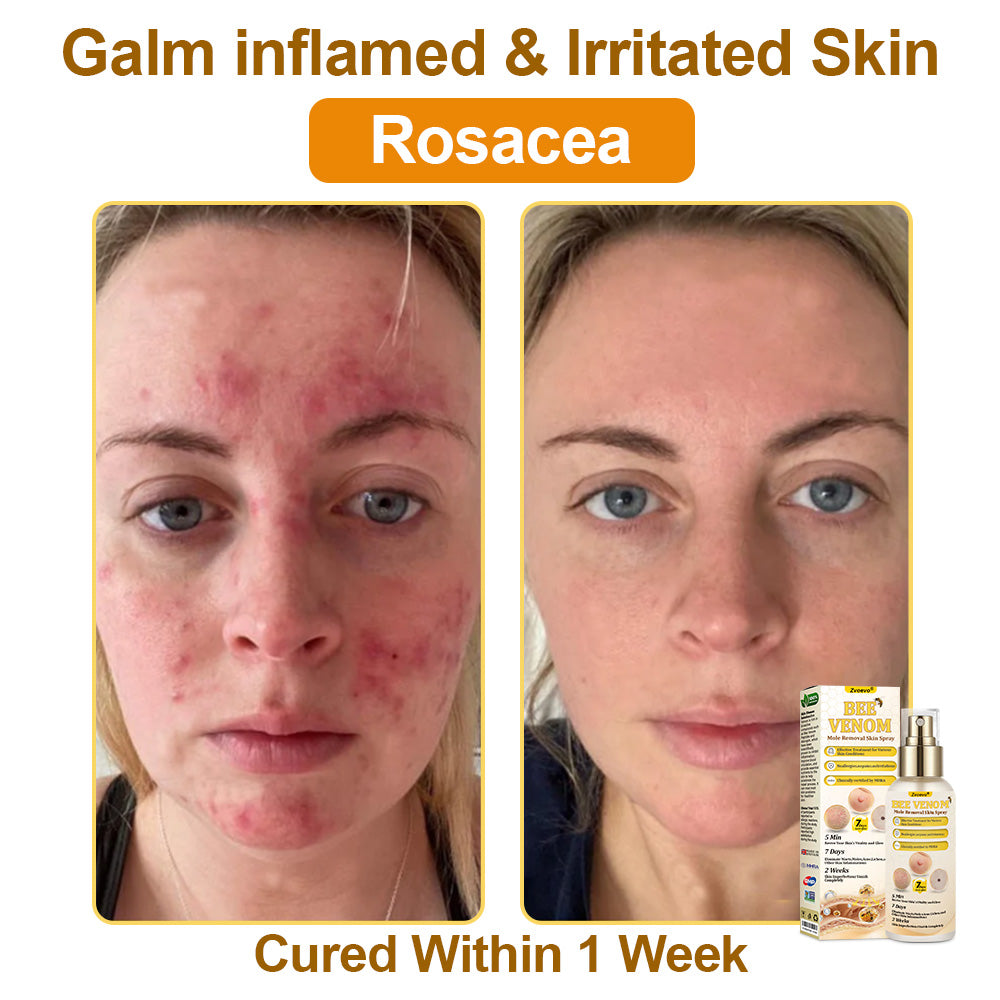 🐝𝐳𝐯𝐨𝐞𝐯𝐨® 𝐁𝐞𝐞 𝐕𝐞𝐧𝐨𝐦 𝐒𝐤𝐢𝐧 𝐒𝐩𝐫𝐚𝐲 – Dermatologist-recommended, provides effective relief for stubborn warts, skin bumps, infections, scars, and various skin concerns.