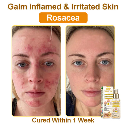 🐝𝐳𝐯𝐨𝐞𝐯𝐨® 𝐁𝐞𝐞 𝐕𝐞𝐧𝐨𝐦 𝐒𝐤𝐢𝐧 𝐒𝐩𝐫𝐚𝐲 – Dermatologist-recommended, provides effective relief for stubborn warts, skin bumps, infections, scars, and various skin concerns.