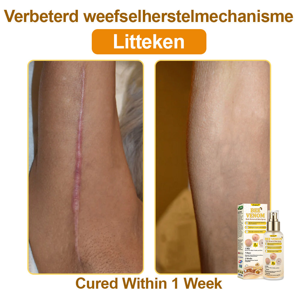 🐝𝐳𝐯𝐨𝐞𝐯𝐨® 𝐁𝐞𝐞 𝐕𝐞𝐧𝐨𝐦 𝐒𝐤𝐢𝐧 𝐒𝐩𝐫𝐚𝐲 – Dermatologist-recommended, provides effective relief for stubborn warts, skin bumps, infections, scars, and various skin concerns.