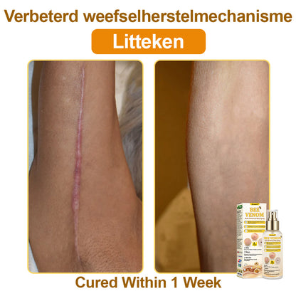 🐝𝐳𝐯𝐨𝐞𝐯𝐨® 𝐁𝐞𝐞 𝐕𝐞𝐧𝐨𝐦 𝐒𝐤𝐢𝐧 𝐒𝐩𝐫𝐚𝐲 – Dermatologist-recommended, provides effective relief for stubborn warts, skin bumps, infections, scars, and various skin concerns.