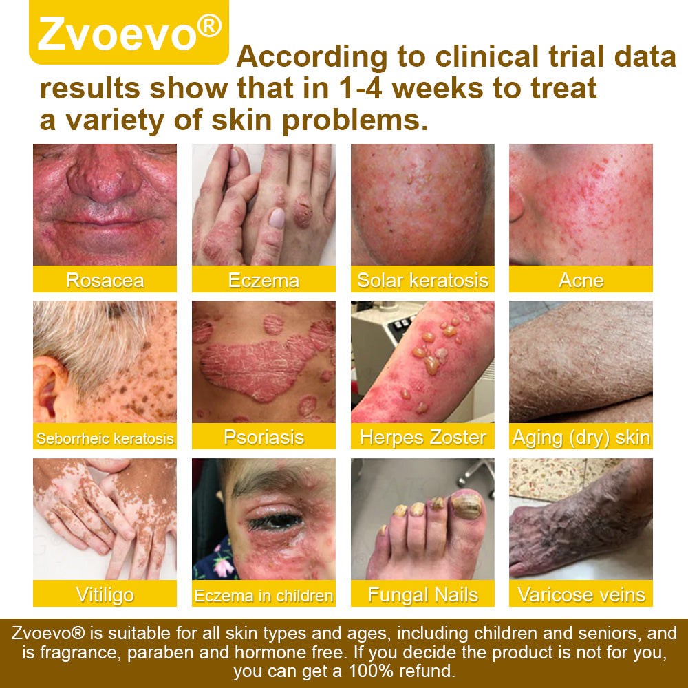 🐝𝐳𝐯𝐨𝐞𝐯𝐨® 𝐁𝐞𝐞 𝐕𝐞𝐧𝐨𝐦 𝐒𝐤𝐢𝐧 𝐒𝐩𝐫𝐚𝐲 – Dermatologist-recommended, provides effective relief for stubborn warts, skin bumps, infections, scars, and various skin concerns.