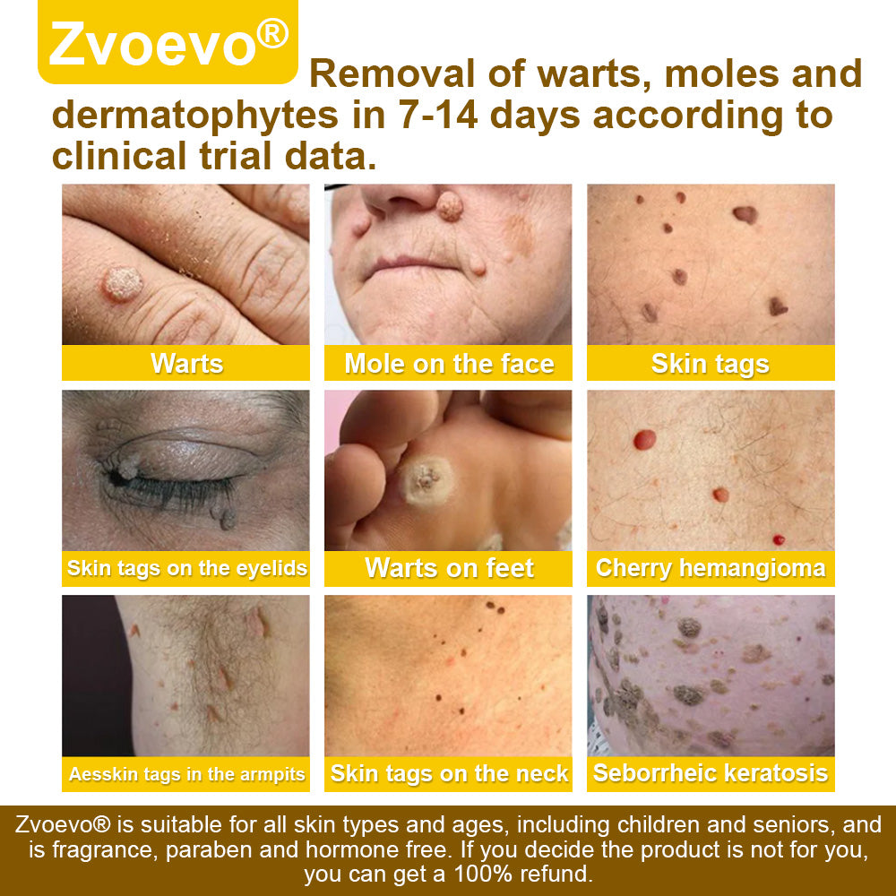 🐝𝐳𝐯𝐨𝐞𝐯𝐨® 𝐁𝐞𝐞 𝐕𝐞𝐧𝐨𝐦 𝐒𝐤𝐢𝐧 𝐒𝐩𝐫𝐚𝐲 – Dermatologist-recommended, provides effective relief for stubborn warts, skin bumps, infections, scars, and various skin concerns.