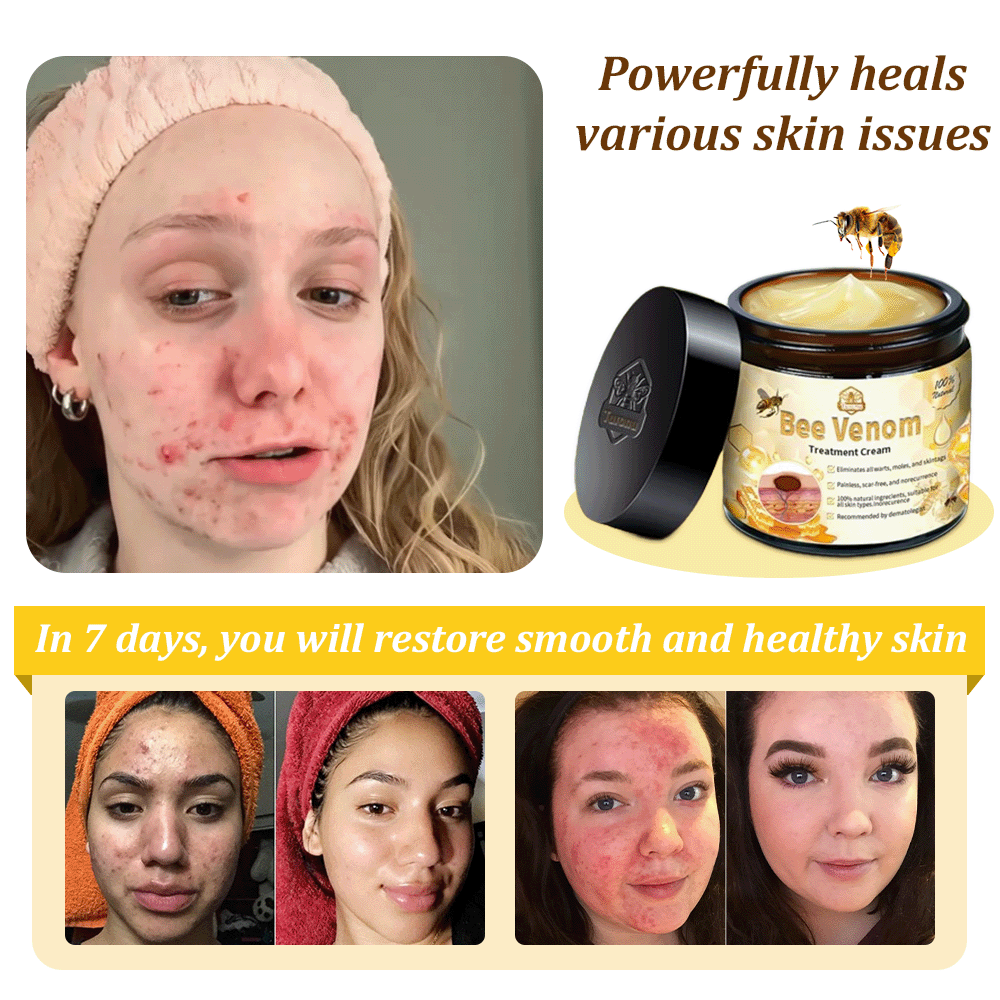 🌿🐝Turonu™ Bee Venom Skin Treatment Cream (✅ Meets UK Dermatology Standards)