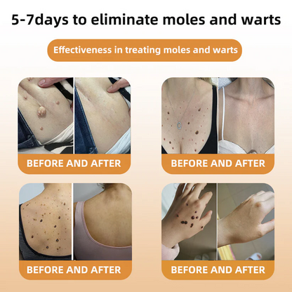 🌿🌿flysmus™ Bee Venom Mole and Wart Treatment Cream (AAD RECOMMENDS)