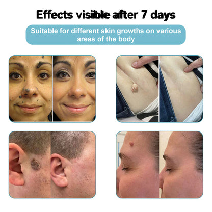 👨‍⚕️Bikenda® Medical-Grade Wart Removal Laser Pen