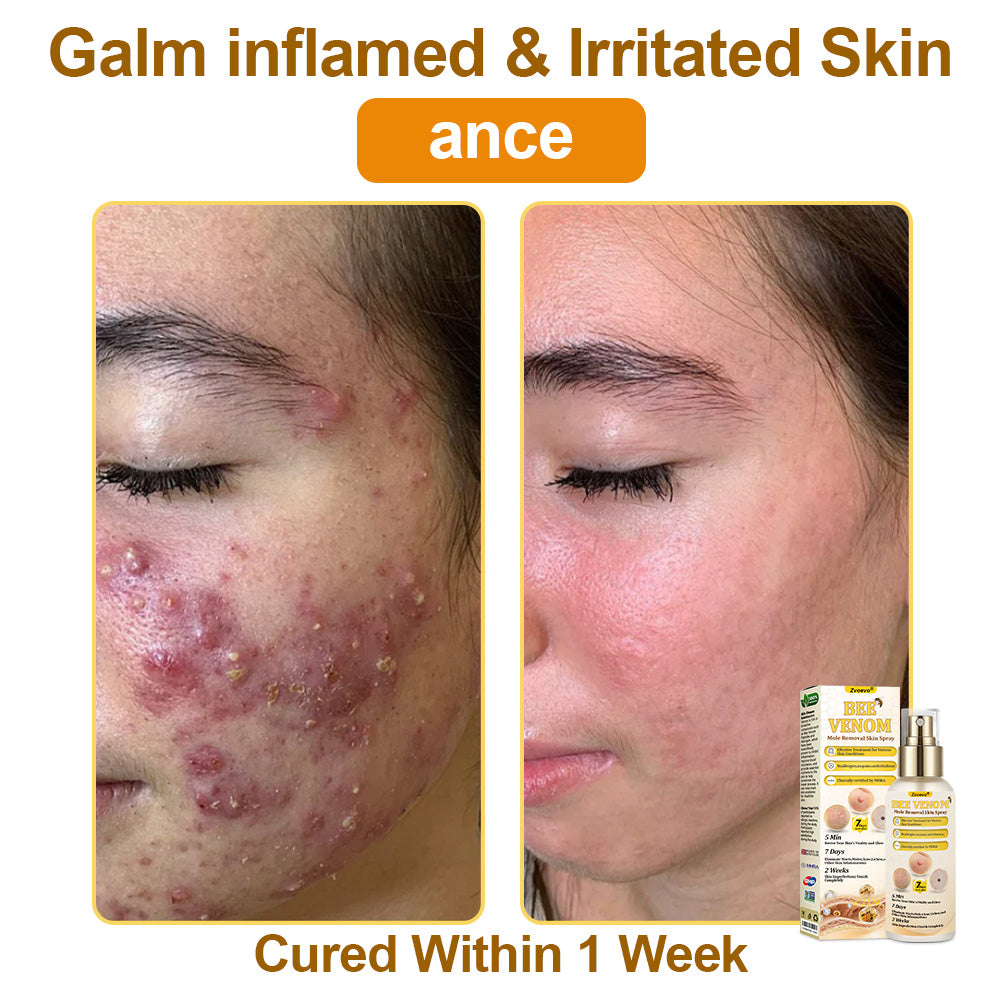 🐝𝐳𝐯𝐨𝐞𝐯𝐨® 𝐁𝐞𝐞 𝐕𝐞𝐧𝐨𝐦 𝐒𝐤𝐢𝐧 𝐒𝐩𝐫𝐚𝐲 – Dermatologist-recommended, provides effective relief for stubborn warts, skin bumps, infections, scars, and various skin concerns.