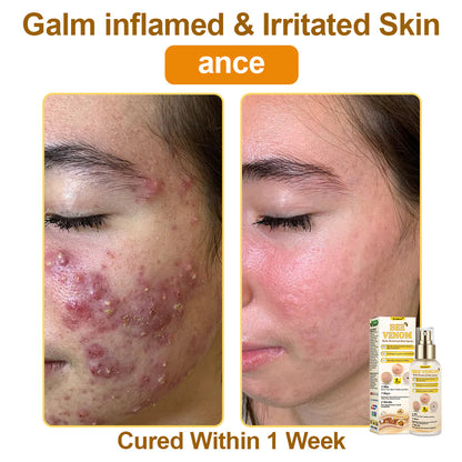 🐝𝐳𝐯𝐨𝐞𝐯𝐨® 𝐁𝐞𝐞 𝐕𝐞𝐧𝐨𝐦 𝐒𝐤𝐢𝐧 𝐒𝐩𝐫𝐚𝐲 – Dermatologist-recommended, provides effective relief for stubborn warts, skin bumps, infections, scars, and various skin concerns.