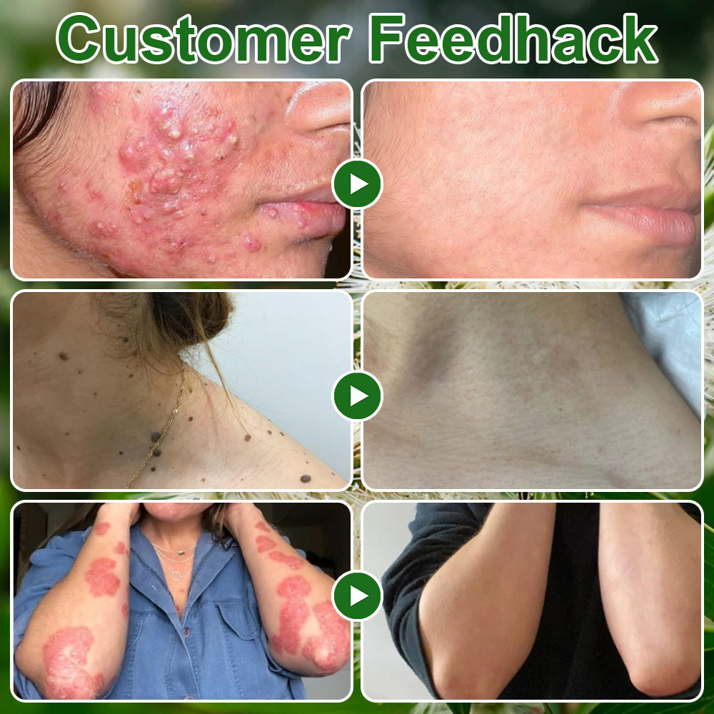 ✅𝐌𝐇𝐑𝐀-𝐀𝐏𝐏𝐑𝐎𝐕𝐄𝐃 🌿𝐳𝐯𝐨𝐞𝐯𝐨® 𝐓𝐞𝐚 𝐓𝐫𝐞𝐞 𝐎𝐢𝐥 𝐒𝐤𝐢𝐧 𝐓𝐫𝐞𝐚𝐭𝐦𝐞𝐧𝐭 𝐂𝐫𝐞𝐚𝐦 – Removes Skin Blemishes, Repairs Damaged Skin, Brightens & Anti-Ageing Care