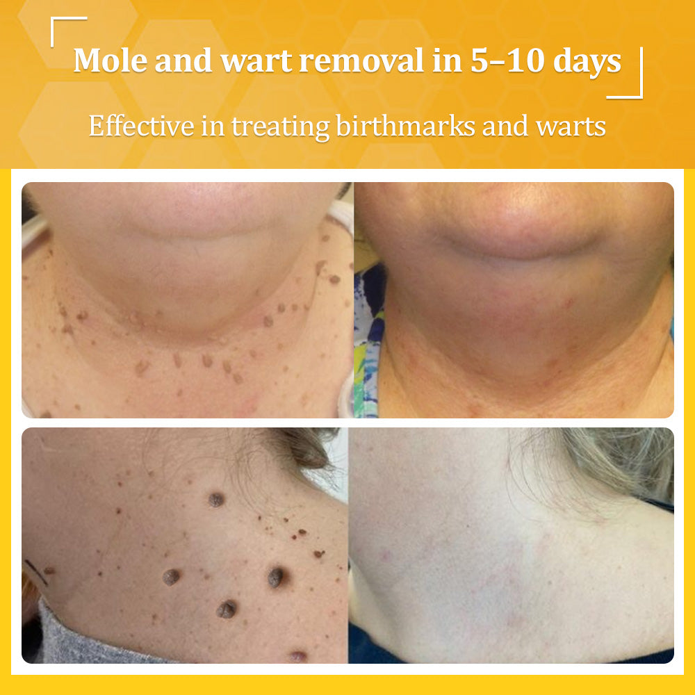 💙𝐌𝐇𝐑𝐀-𝐀𝐏𝐏𝐑𝐎𝐕𝐄𝐃 🐝𝐟𝐥𝐲𝐬𝐦𝐮𝐬® 𝐁𝐞𝐞 𝐕𝐞𝐧𝐨𝐦 𝐀𝐥𝐥-𝐢𝐧-𝐎𝐧𝐞 𝐂𝐫𝐞𝐚𝐦 – Provides effective relief for stubborn warts, skin bumps, lesions, infections, and scars.Up