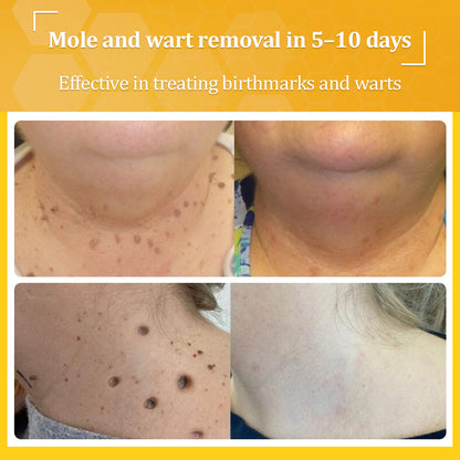 💙𝐌𝐇𝐑𝐀-𝐀𝐏𝐏𝐑𝐎𝐕𝐄𝐃 🐝𝐟𝐥𝐲𝐬𝐦𝐮𝐬® 𝐁𝐞𝐞 𝐕𝐞𝐧𝐨𝐦 𝐀𝐥𝐥-𝐢𝐧-𝐎𝐧𝐞 𝐂𝐫𝐞𝐚𝐦 – Provides effective relief for stubborn warts, skin bumps, lesions, infections, and scars.Up