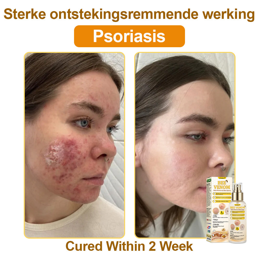 🐝𝐳𝐯𝐨𝐞𝐯𝐨® 𝐁𝐞𝐞 𝐕𝐞𝐧𝐨𝐦 𝐒𝐤𝐢𝐧 𝐒𝐩𝐫𝐚𝐲 – Dermatologist-recommended, provides effective relief for stubborn warts, skin bumps, infections, scars, and various skin concerns.