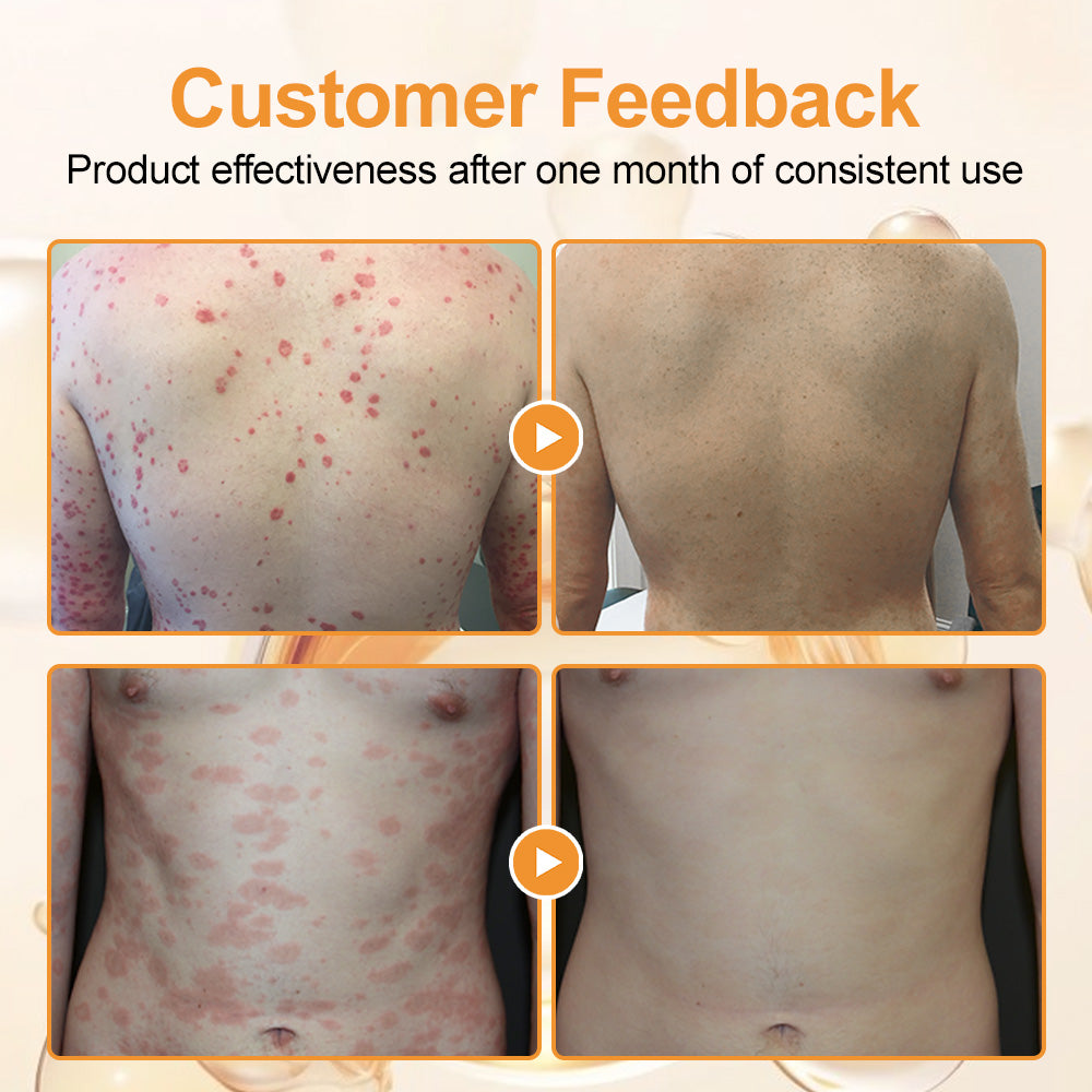 flysmus™ Bee Venom Eczema & Psoriasis Relief Cream – Soothes & Relieves Itching