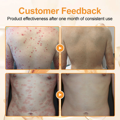 flysmus™ Bee Venom Eczema & Psoriasis Relief Cream – Soothes & Relieves Itching
