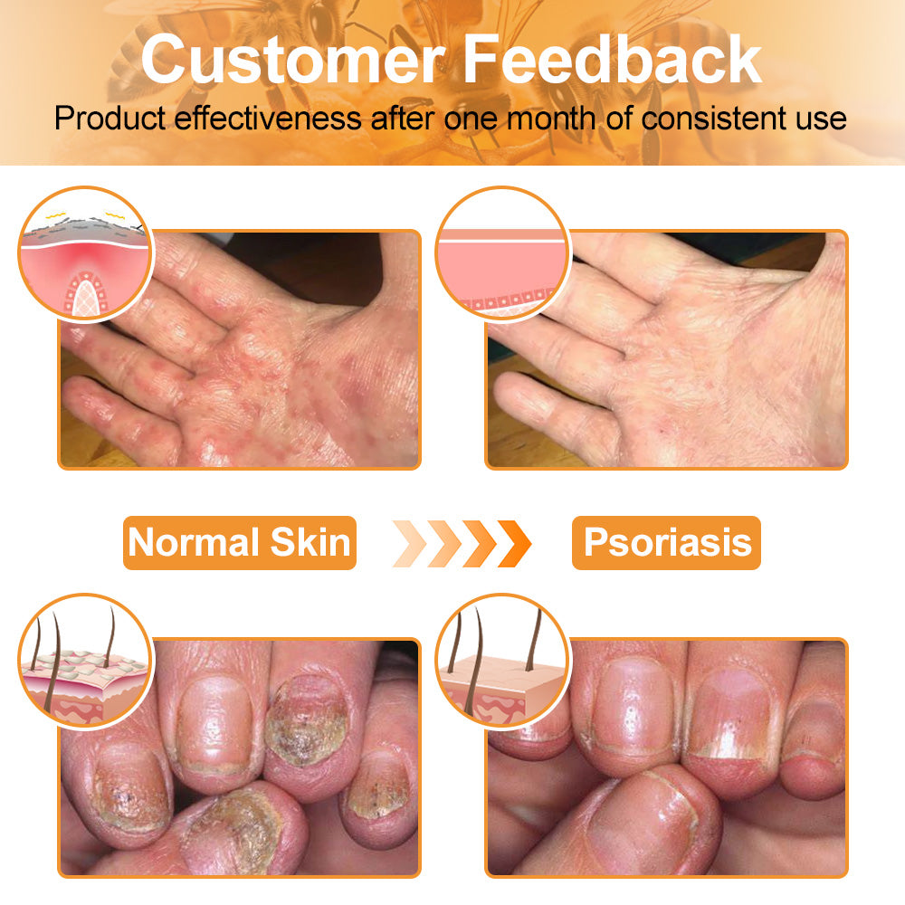 flysmus™ Bee Venom Eczema & Psoriasis Relief Cream – Soothes & Relieves Itching