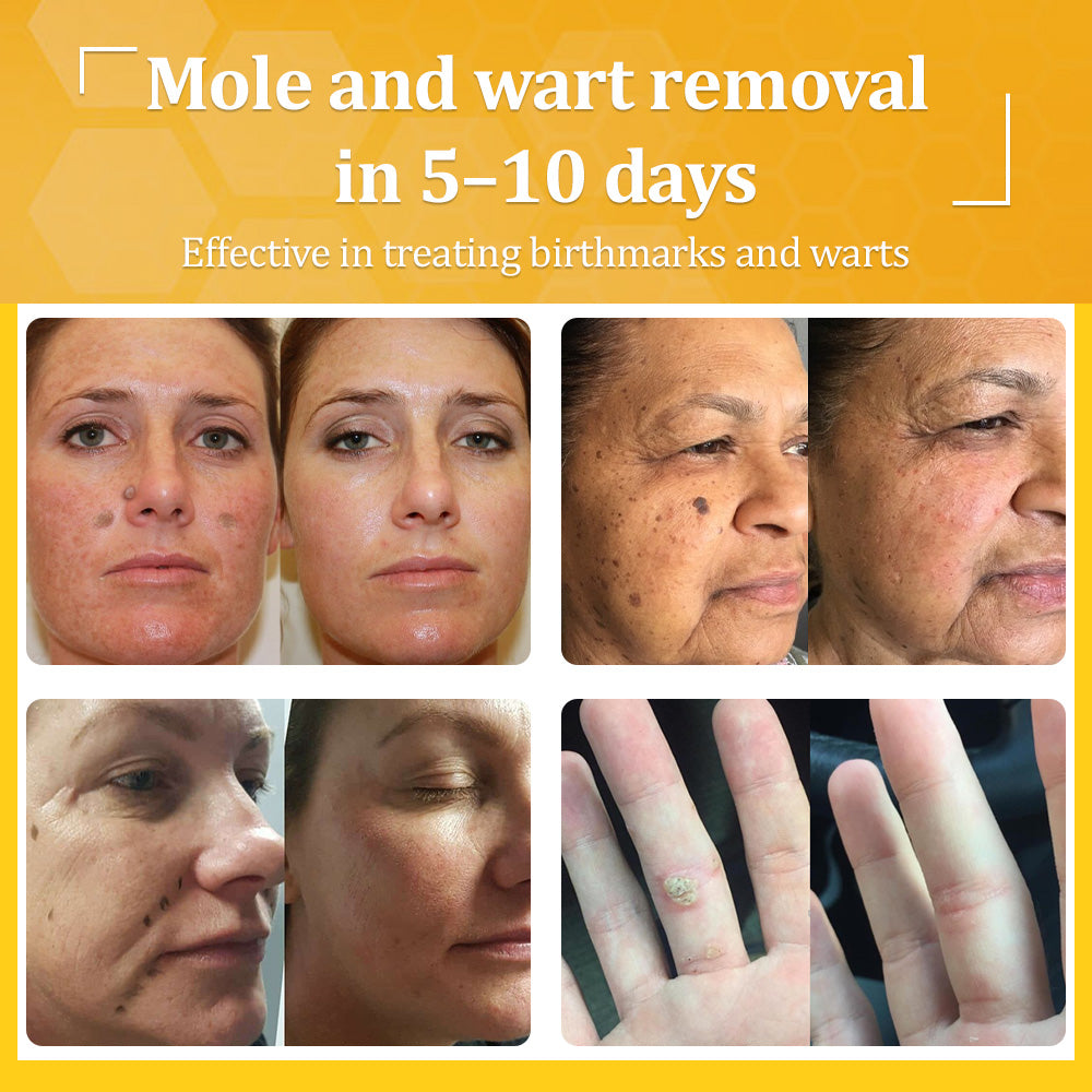 💙𝐌𝐇𝐑𝐀-𝐀𝐏𝐏𝐑𝐎𝐕𝐄𝐃 🐝𝐟𝐥𝐲𝐬𝐦𝐮𝐬® 𝐁𝐞𝐞 𝐕𝐞𝐧𝐨𝐦 𝐀𝐥𝐥-𝐢𝐧-𝐎𝐧𝐞 𝐂𝐫𝐞𝐚𝐦 – Provides effective relief for stubborn warts, skin bumps, lesions, infections, and scars.Up