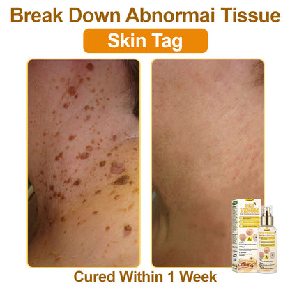 🐝𝐳𝐯𝐨𝐞𝐯𝐨® 𝐁𝐞𝐞 𝐕𝐞𝐧𝐨𝐦 𝐒𝐤𝐢𝐧 𝐒𝐩𝐫𝐚𝐲 – Dermatologist-recommended, provides effective relief for stubborn warts, skin bumps, infections, scars, and various skin concerns.