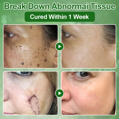 ✅𝐌𝐇𝐑𝐀-𝐀𝐏𝐏𝐑𝐎𝐕𝐄𝐃 🌿𝐳𝐯𝐨𝐞𝐯𝐨® 𝐓𝐞𝐚 𝐓𝐫𝐞𝐞 𝐎𝐢𝐥 𝐒𝐤𝐢𝐧 𝐓𝐫𝐞𝐚𝐭𝐦𝐞𝐧𝐭 𝐂𝐫𝐞𝐚𝐦 – Removes Skin Blemishes, Repairs Damaged Skin, Brightens & Anti-Ageing Care