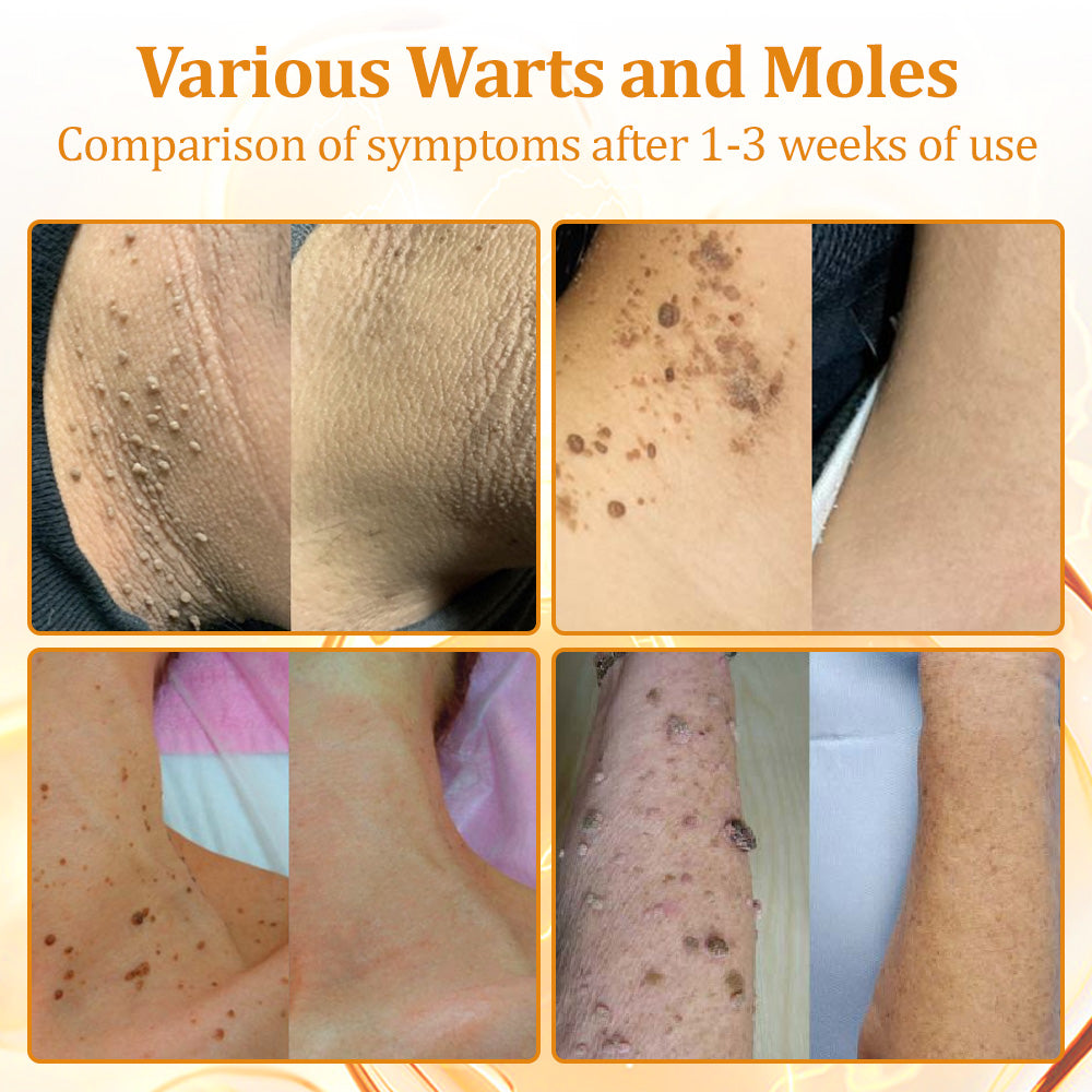 flysmus™Tagheal Bee Venom Mole and Wart Treatment Cream🐝(🔥 Last  day promotion 70% off🔥)