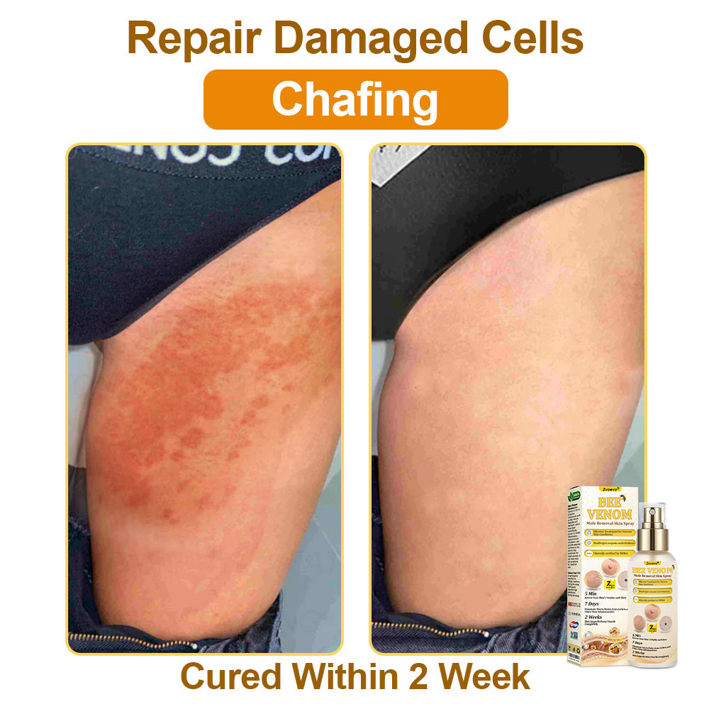🐝𝐳𝐯𝐨𝐞𝐯𝐨® 𝐁𝐞𝐞 𝐕𝐞𝐧𝐨𝐦 𝐒𝐤𝐢𝐧 𝐒𝐩𝐫𝐚𝐲 – Dermatologist-recommended, provides effective relief for stubborn warts, skin bumps, infections, scars, and various skin concerns.