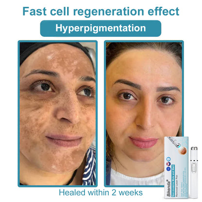 👨‍⚕️Bikenda® Medical-Grade Wart Removal Laser Pen