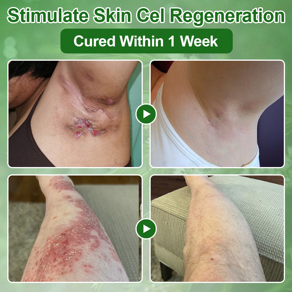 ✅𝐌𝐇𝐑𝐀-𝐀𝐏𝐏𝐑𝐎𝐕𝐄𝐃 🌿𝐳𝐯𝐨𝐞𝐯𝐨® 𝐓𝐞𝐚 𝐓𝐫𝐞𝐞 𝐎𝐢𝐥 𝐒𝐤𝐢𝐧 𝐓𝐫𝐞𝐚𝐭𝐦𝐞𝐧𝐭 𝐂𝐫𝐞𝐚𝐦 – Removes Skin Blemishes, Repairs Damaged Skin, Brightens & Anti-Ageing Care