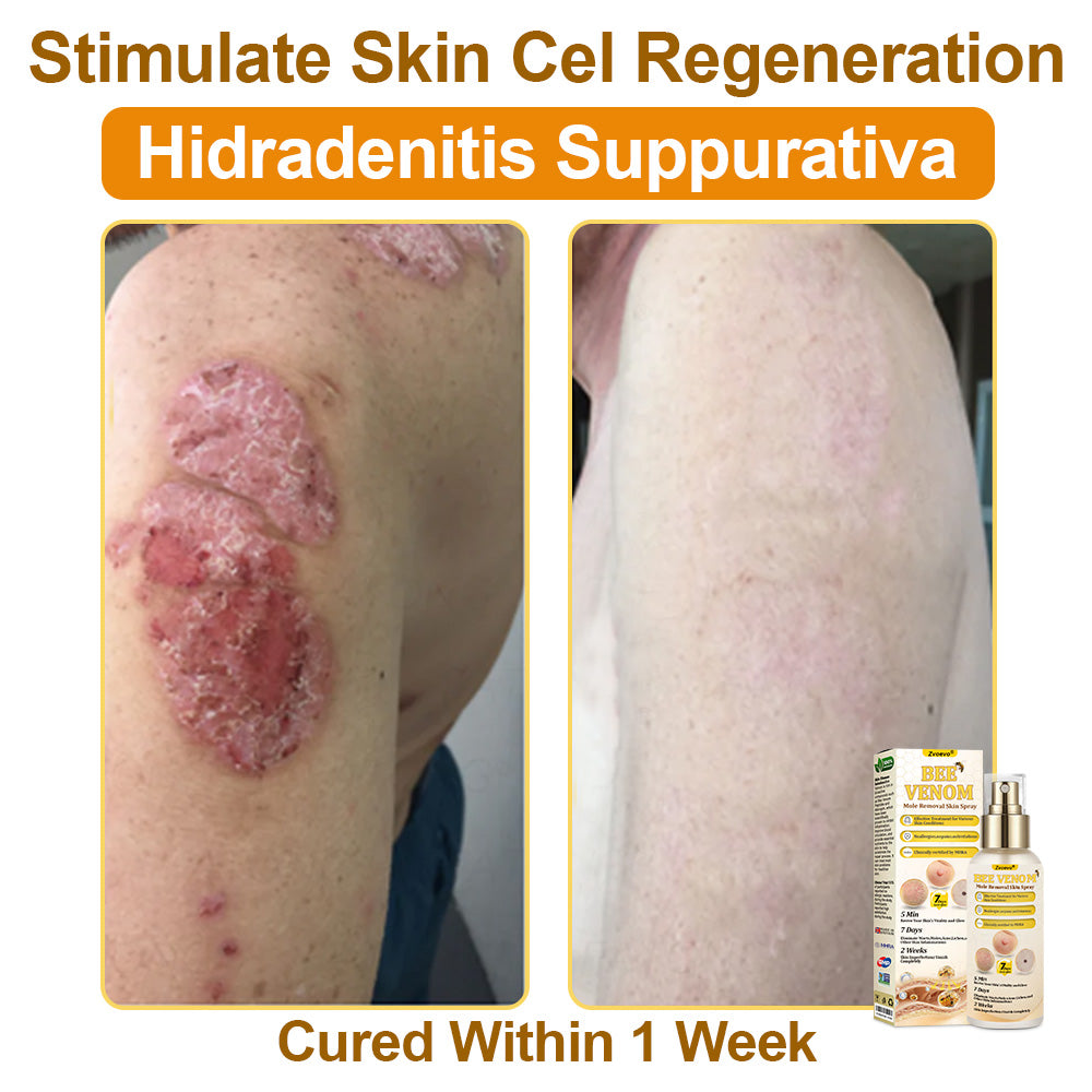 🐝𝐳𝐯𝐨𝐞𝐯𝐨® 𝐁𝐞𝐞 𝐕𝐞𝐧𝐨𝐦 𝐒𝐤𝐢𝐧 𝐒𝐩𝐫𝐚𝐲 – Dermatologist-recommended, provides effective relief for stubborn warts, skin bumps, infections, scars, and various skin concerns.