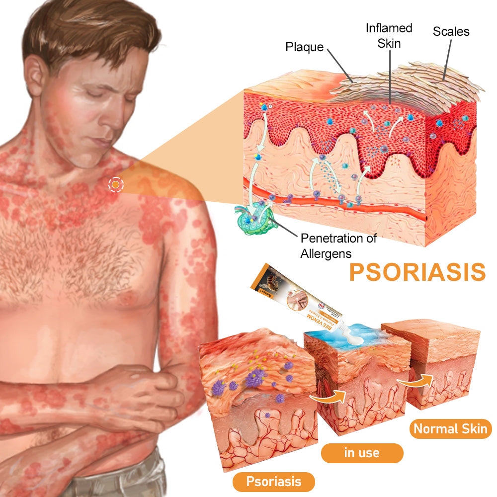 flysmus™ Bee Venom Eczema & Psoriasis Relief Cream – Soothes & Relieves Itching