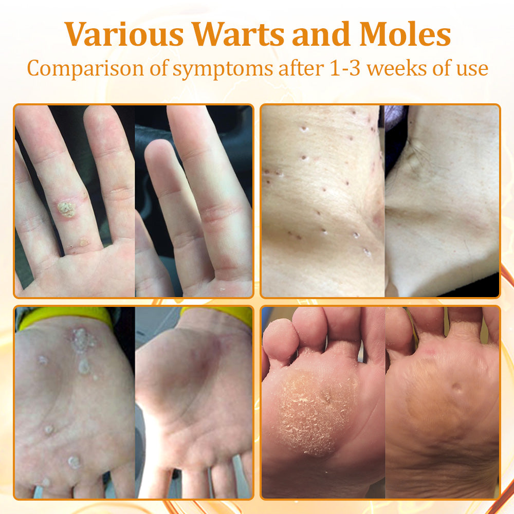 flysmus™Tagheal Bee Venom Mole and Wart Treatment Cream🐝(🔥 Last  day promotion 70% off🔥)