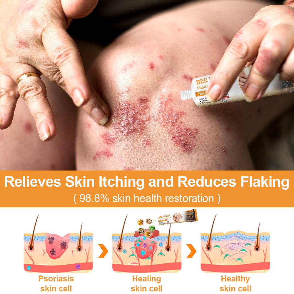 flysmus™ Bee Venom Eczema & Psoriasis Relief Cream – Soothes & Relieves Itching