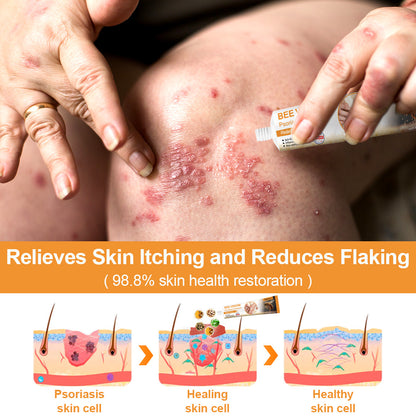 flysmus™ Bee Venom Eczema & Psoriasis Relief Cream – Soothes & Relieves Itching