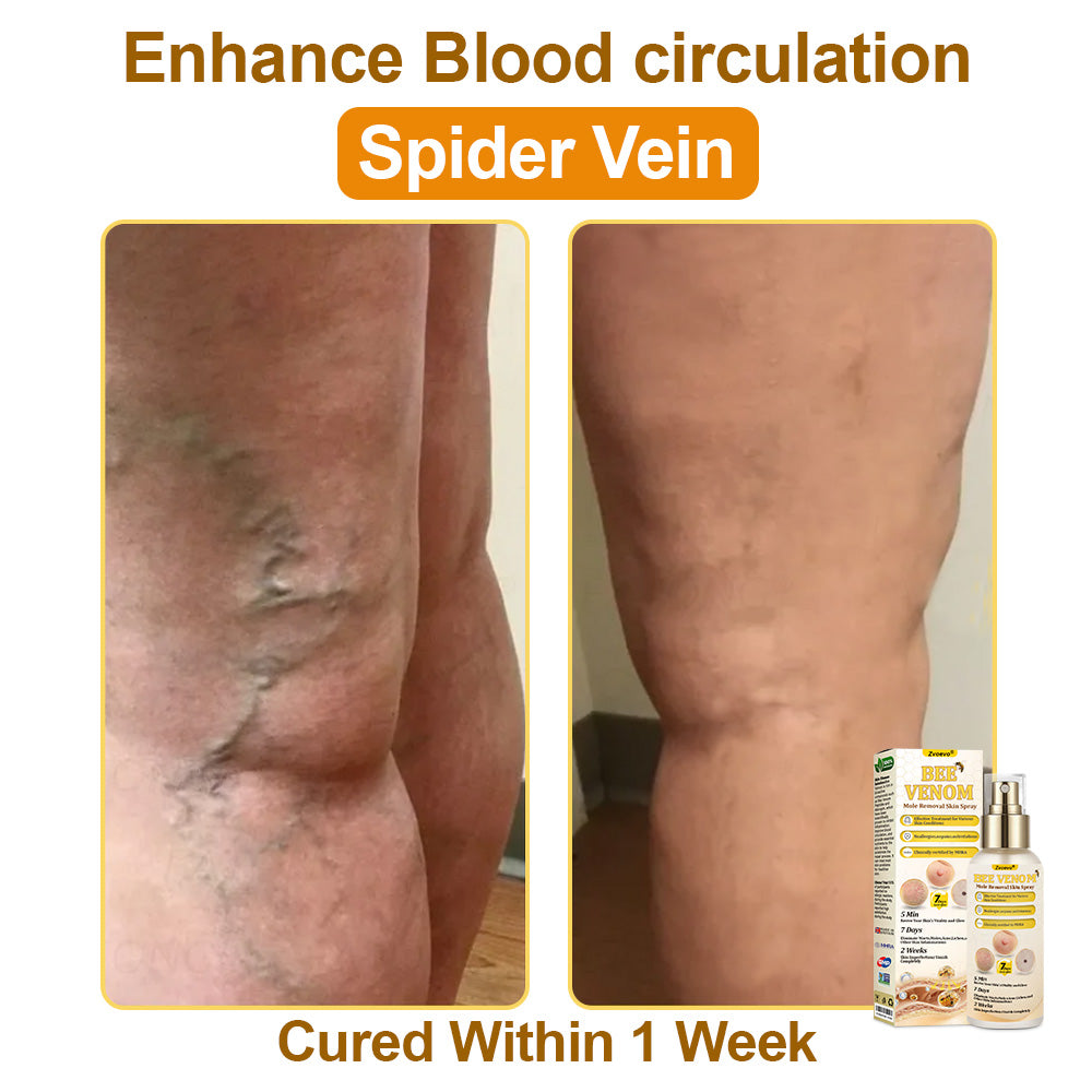 🐝𝐳𝐯𝐨𝐞𝐯𝐨® 𝐁𝐞𝐞 𝐕𝐞𝐧𝐨𝐦 𝐒𝐤𝐢𝐧 𝐒𝐩𝐫𝐚𝐲 – Dermatologist-recommended, provides effective relief for stubborn warts, skin bumps, infections, scars, and various skin concerns.