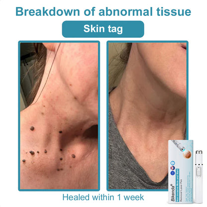 👨‍⚕️Bikenda® Medical-Grade Wart Removal Laser Pen