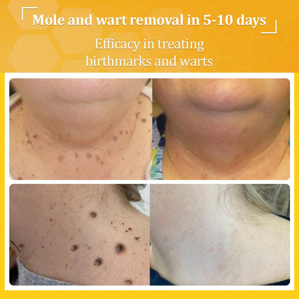 flysmus™ TagCure Bee Venom Wart & Moles Removal Cream🐝