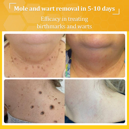 flysmus™ TagCure Bee Venom Wart & Moles Removal Cream🐝