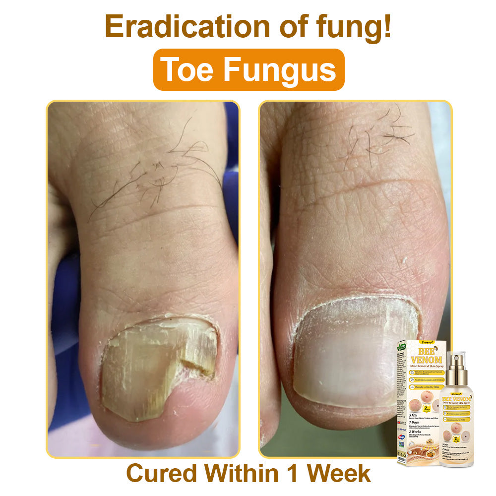 🐝𝐳𝐯𝐨𝐞𝐯𝐨® 𝐁𝐞𝐞 𝐕𝐞𝐧𝐨𝐦 𝐒𝐤𝐢𝐧 𝐒𝐩𝐫𝐚𝐲 – Dermatologist-recommended, provides effective relief for stubborn warts, skin bumps, infections, scars, and various skin concerns.