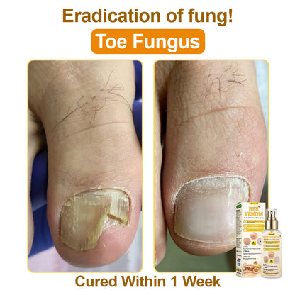🐝𝐳𝐯𝐨𝐞𝐯𝐨® 𝐁𝐞𝐞 𝐕𝐞𝐧𝐨𝐦 𝐒𝐤𝐢𝐧 𝐒𝐩𝐫𝐚𝐲 – Dermatologist-recommended, provides effective relief for stubborn warts, skin bumps, infections, scars, and various skin concerns.