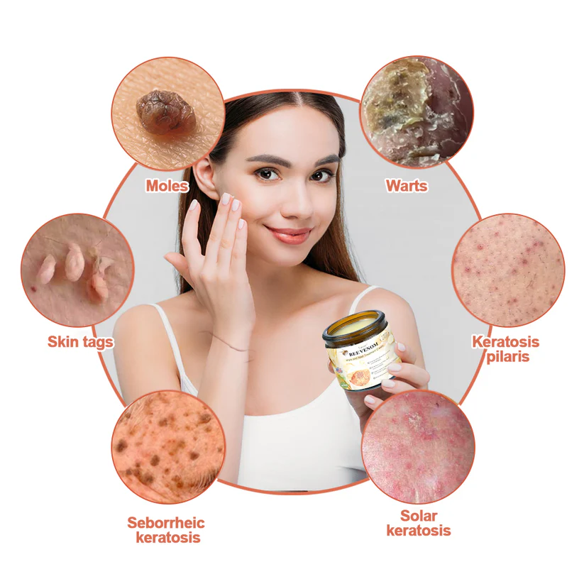 🌿🌿flysmus™ Bee Venom Mole and Wart Treatment Cream (AAD RECOMMENDS)