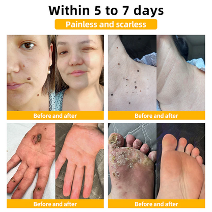 🌿🌿flysmus™ Bee Venom Mole and Wart Treatment Cream (AAD RECOMMENDS)